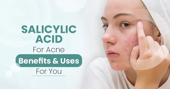 Salicylic acid for acne