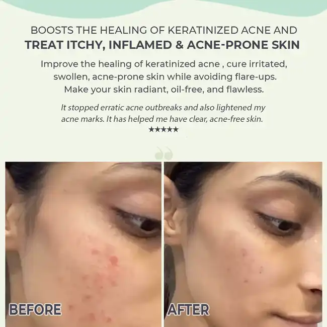 Azelaic Acid for Acne